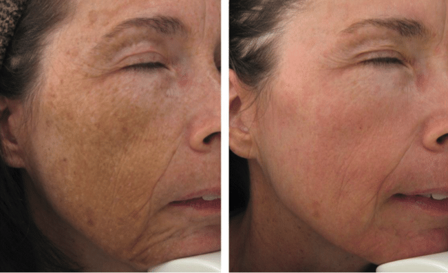 Fraxel Laser Before And After The Ultimate Skincare Hack - 6ubx3kk