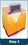 LipoSonix® | Fat Reduction | San Francisco CA | Oakland | Bay Area