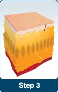 LipoSonix® | Fat Reduction | San Francisco CA | Oakland | Bay Area