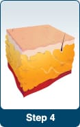 LipoSonix® | Fat Reduction | San Francisco CA | Oakland | Bay Area