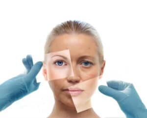 facial rejuvenation