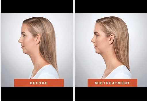 Screen Shot 2018-11-21 at 11.37.23 AM Kybella®