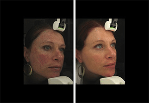 Outcomes Of Intense Pulsed Light Therapy For Treatment Of Evaporative Dry Eye Disease Sciencedirect