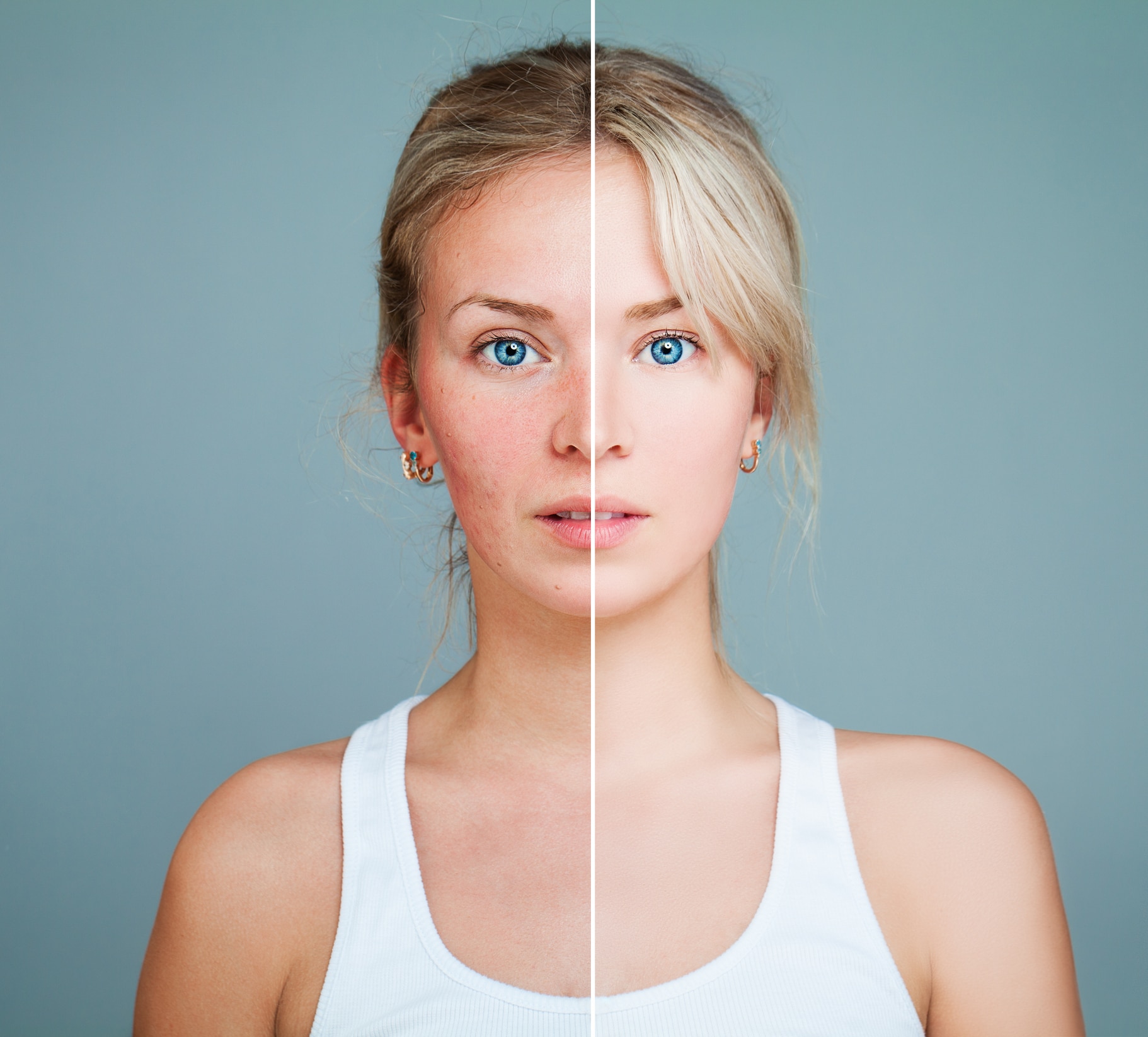 Young Model Woman with Skin Problem. Female Face Divided into two Parts one Healthy and one Unhealthy. Facial Treatment, Medicine and Cosmetology Concept