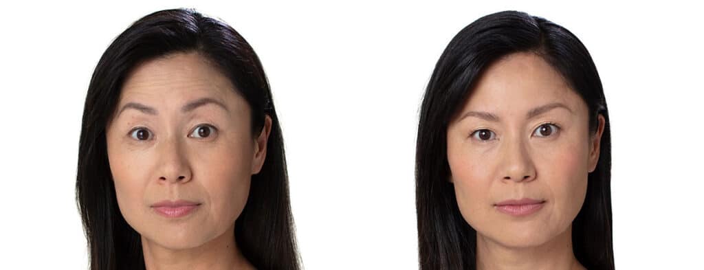 Before and After of Botox treatment forehead