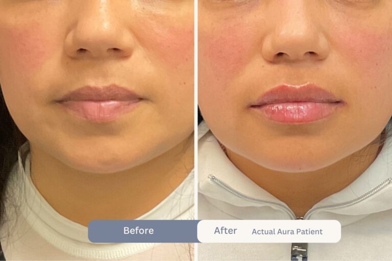 Aura Patient B&A 01
