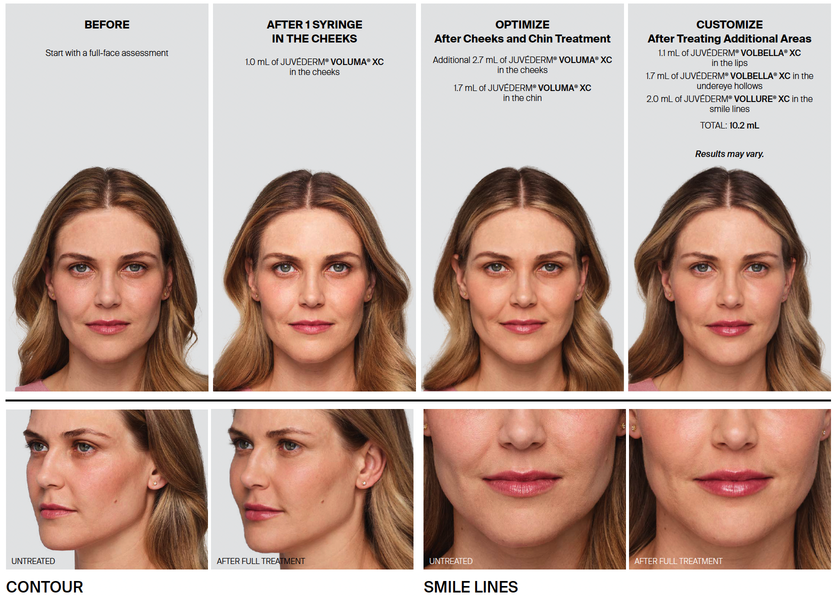 Juvederm 01