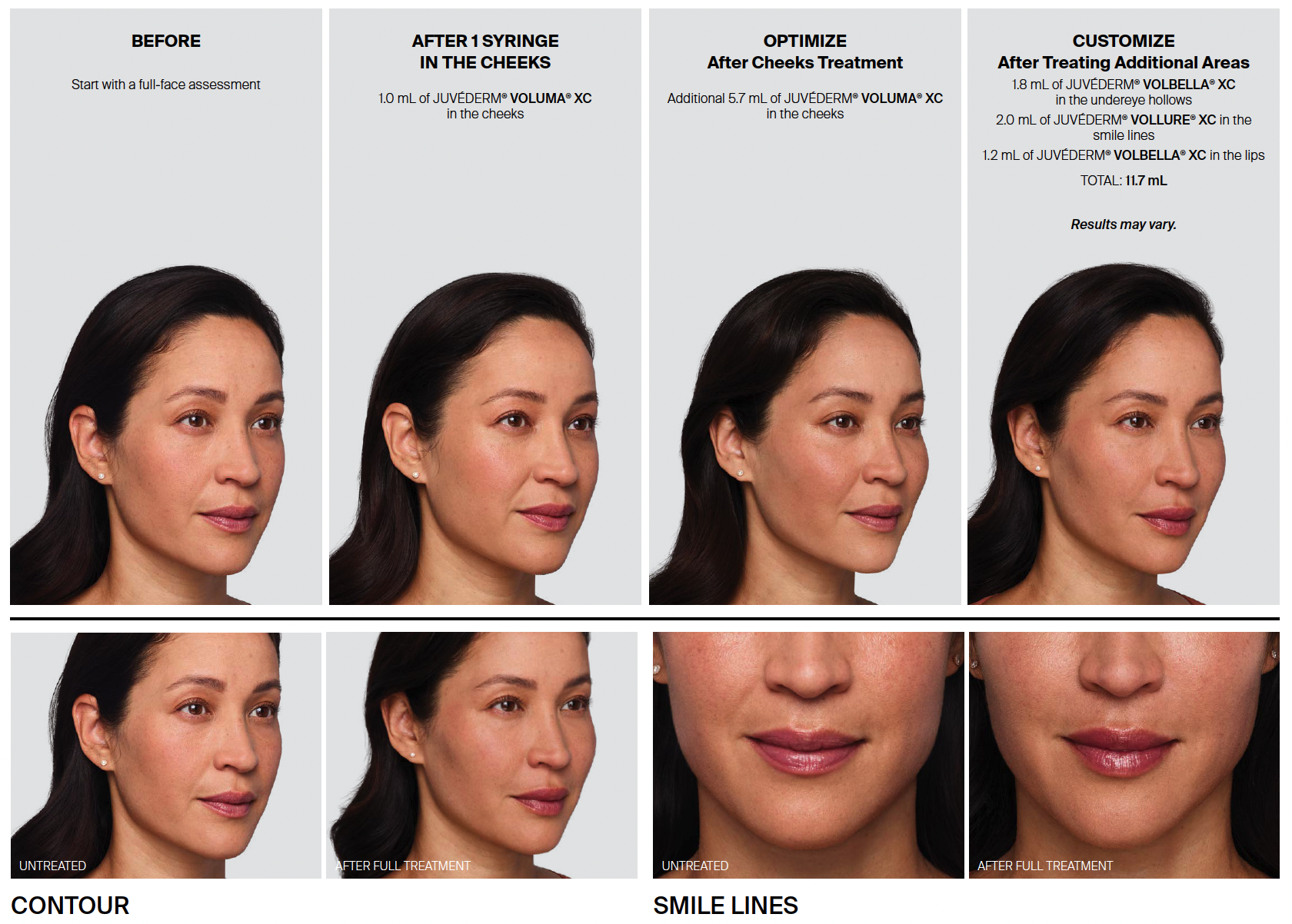 Juvederm 02