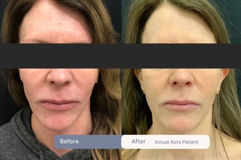 Sculptra B&A 1