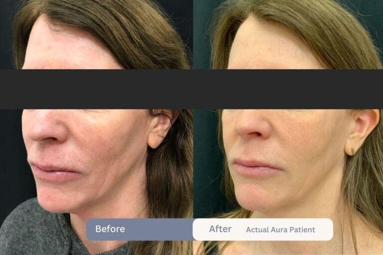 Sculptra B&A 2