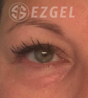 After Image: EZ Gel PRF - front
