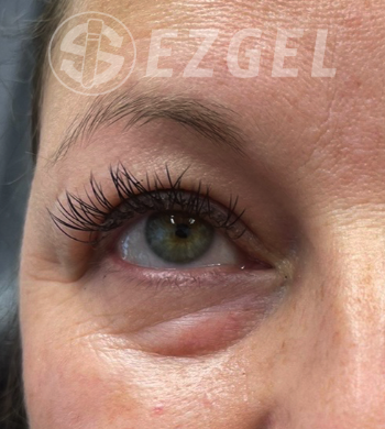 Before Image: EZ Gel PRF - front