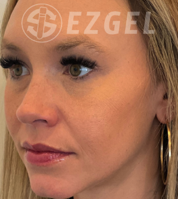 Before Image: EZ Gel PRF - left-front-oblique