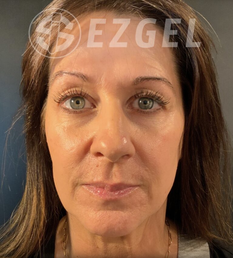 Before Image: EZ Gel PRF - front