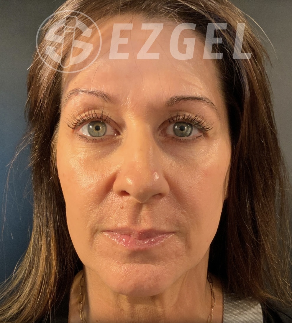 Before Image: EZ Gel PRF - front
