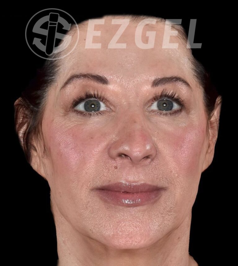 After Image: EZ Gel PRF - front