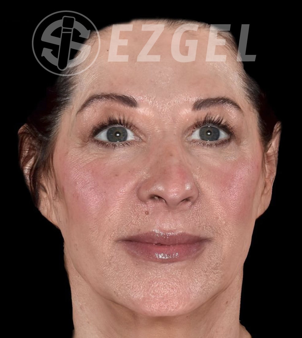 After Image: EZ Gel PRF - front
