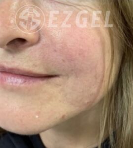 After Image: Ez Gel PRF