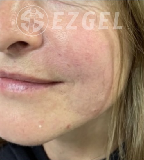 After Image: Ez Gel PRF - left-front-oblique