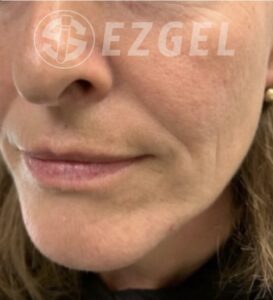 Before Image: Ez Gel PRF