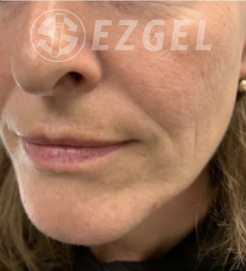 Before Image: Ez Gel PRF - left-front-oblique