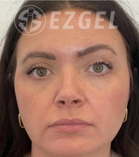 After Image: Ez Gel PRF - front