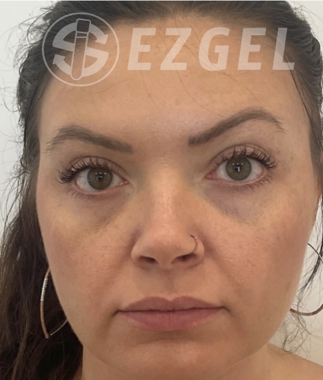 Before Image: Ez Gel PRF - front