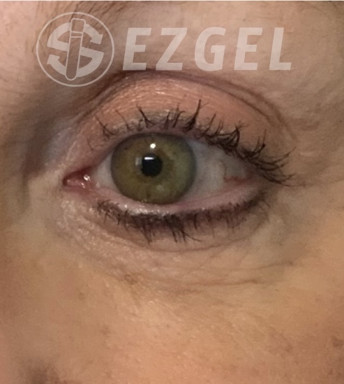 After Image: Ez Gel PRF - front
