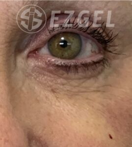 Before Image: Ez Gel PRF