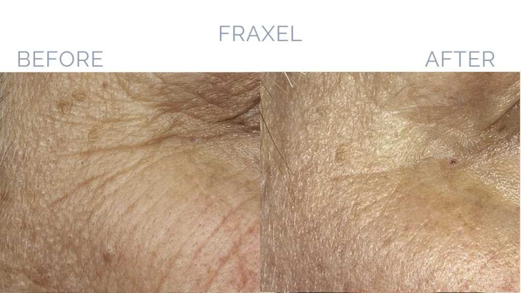 Before and After Image: Fraxel® Dual Patient 1 - front