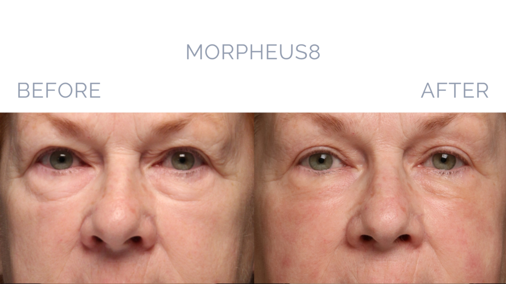 Before and After Image: MORPHEUS8 Patient 1 - front