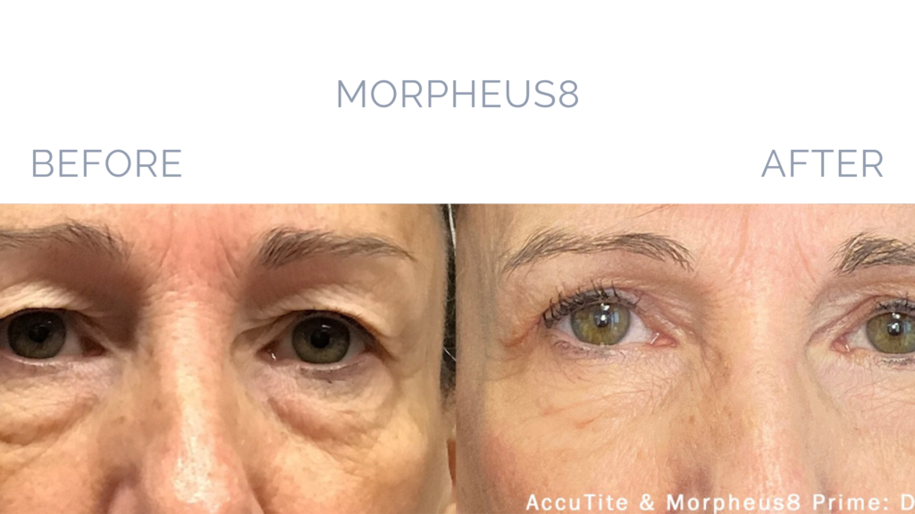 Before and After Image: MORPHEUS8 Patient 2 - front