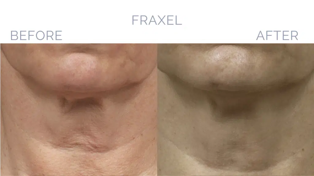 Before and After Image: Fraxel® Dual Patient 2 - front