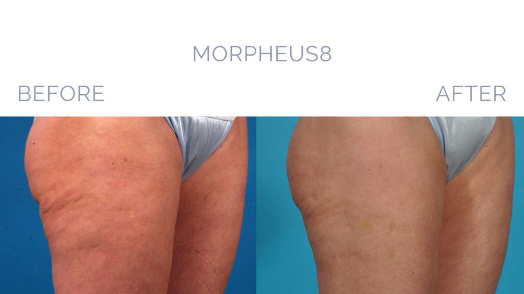 Before and After Image: MORPHEUS8 Patient 3 - right-front-oblique