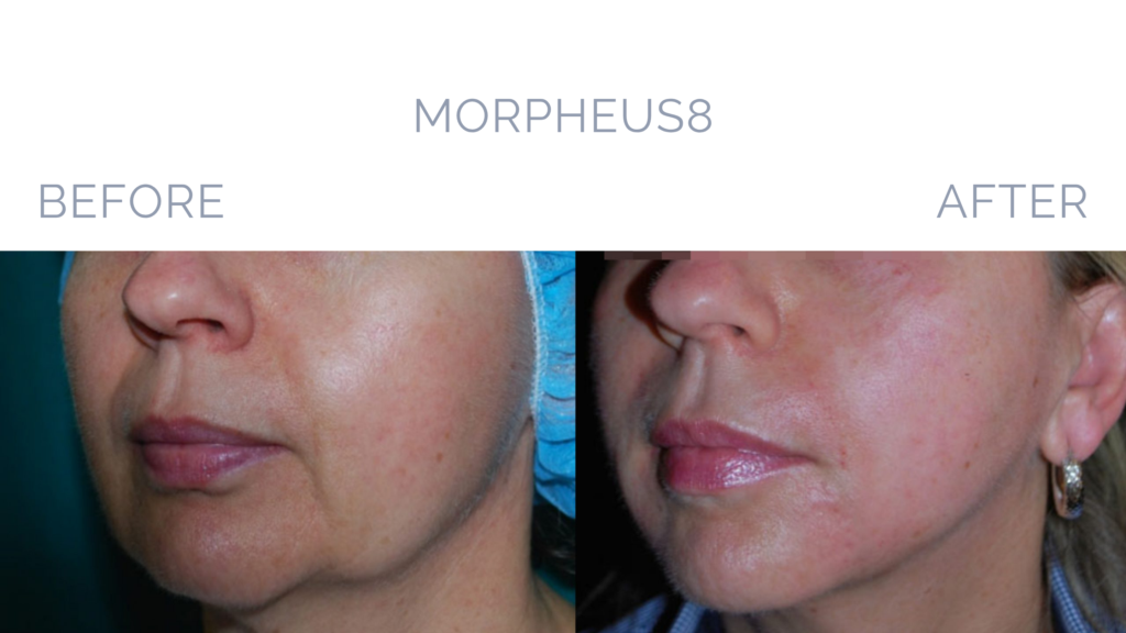 Before and After Image: MORPHEUS8 Patient 4 - left-front-oblique