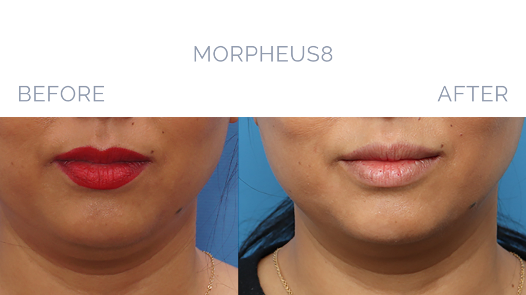 Before and After Image: MORPHEUS8 Patient 5 - front