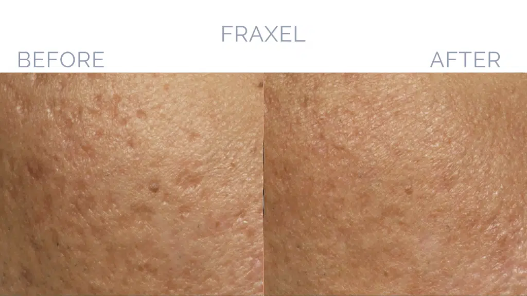 Before and After Image: Fraxel® Dual Patient 3 - front
