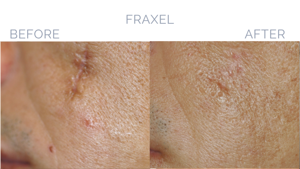 Before and After Image: Fraxel® Dual Patient 4 - front