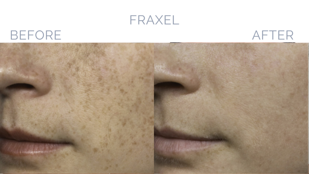 Before and After Image: Fraxel® Dual Patient 5 - front