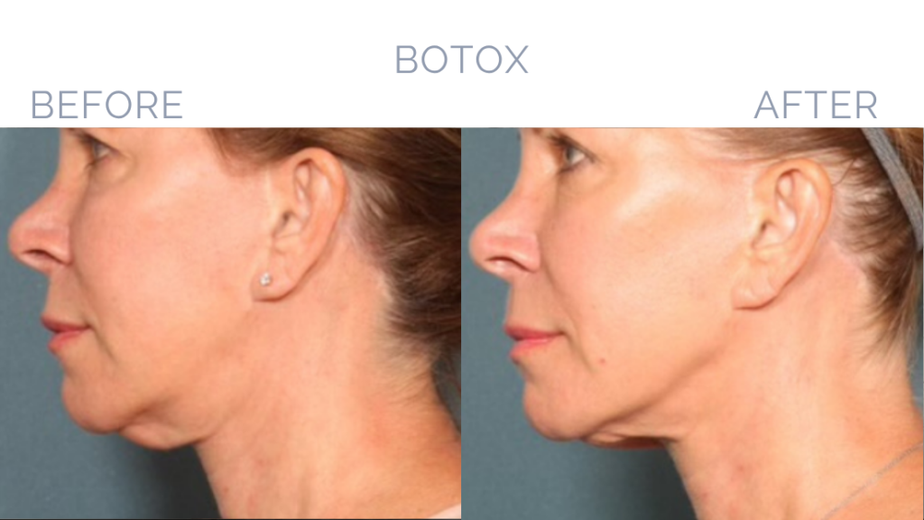 Before and After Image: Fraxel® Dual Patient 6 - left-side
