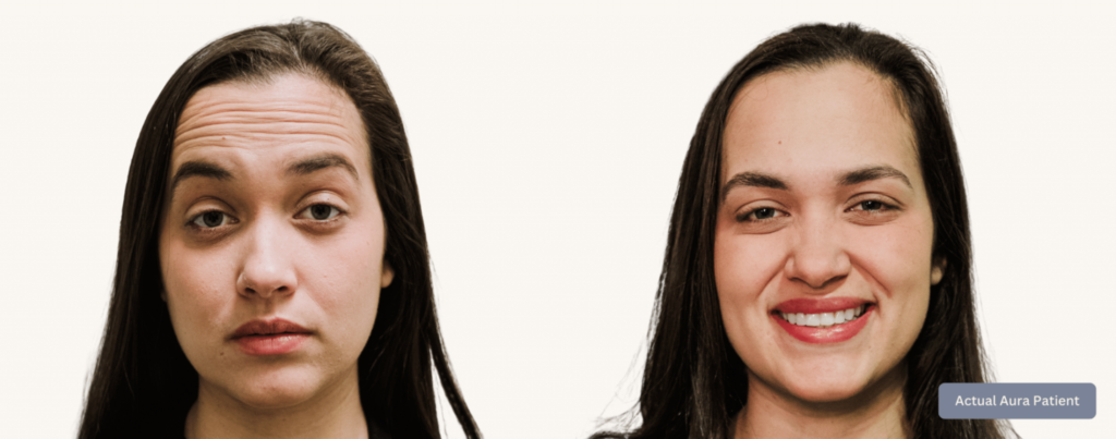 Before and After Image: Botox® Cosmetic Patient 2 - front