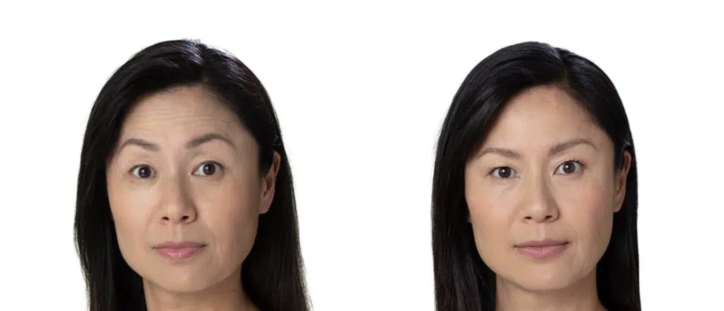 Before and After Image: Botox® Cosmetic Patient 1 - front