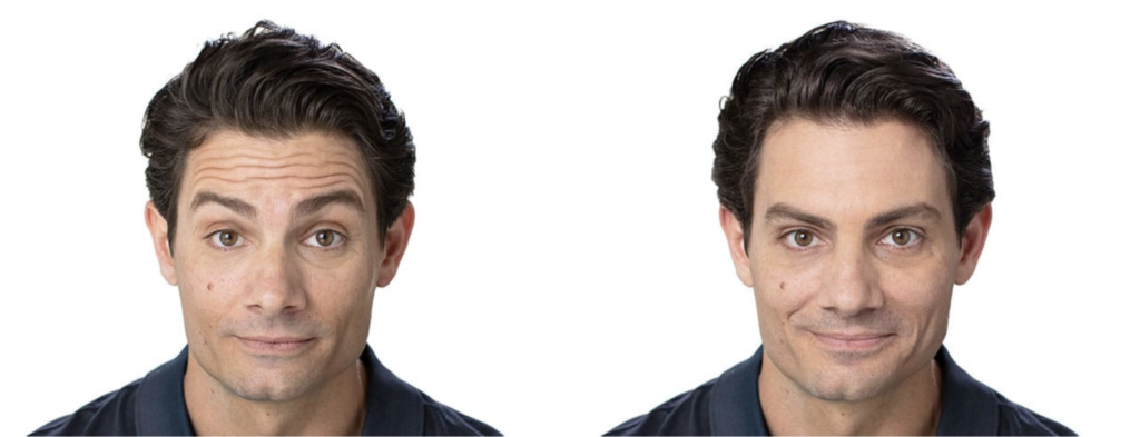 Before and After Image: Botox® Cosmetic Patient 3 - front
