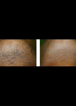After Image: Filler - front
