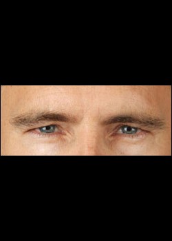 After Image: Botox® Cosmetic Patient 1 - other