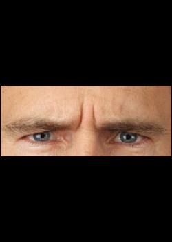 Before Image: Botox® Cosmetic Patient 1 - other
