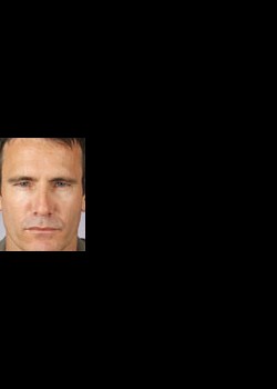 After Image: Botox® Cosmetic Patient 1 - front