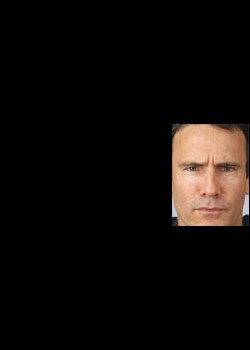 Before Image: Botox® Cosmetic Patient 1 - front