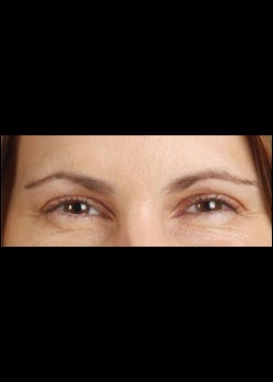 After Image: Botox® Cosmetic Patient 2 - other