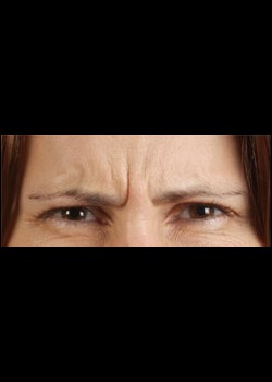 Before Image: Botox® Cosmetic Patient 2 - other